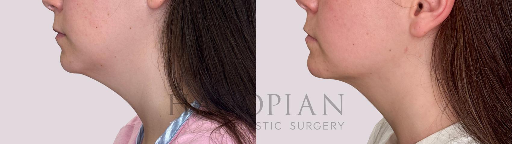 Before & After Chin Liposuction Case 280 Left Side View in Atlanta, GA