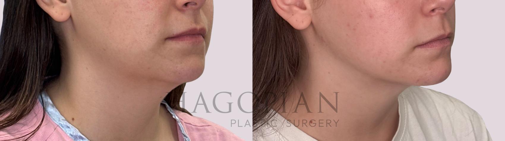 Before & After Chin Liposuction Case 280 Right Oblique View in Atlanta, GA