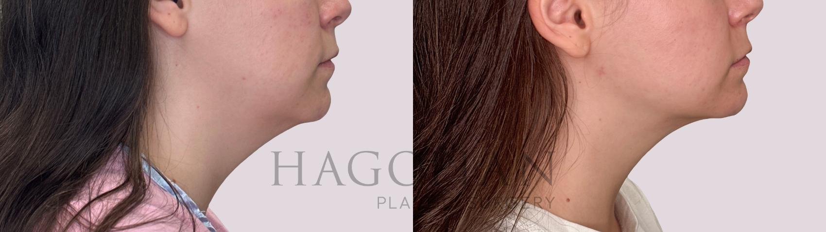 Before & After Chin Liposuction Case 280 Right Side View in Atlanta, GA
