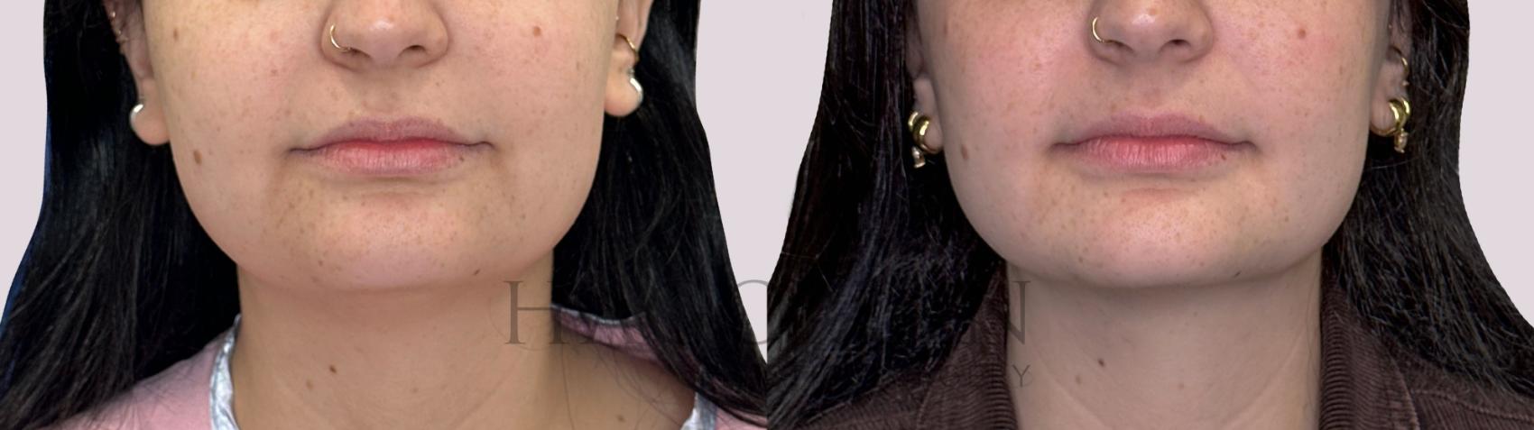 Before & After Chin Liposuction Case 288 Front View in Atlanta, GA