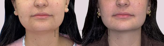 Before & After Chin Liposuction Case 288 Front View in Atlanta, GA
