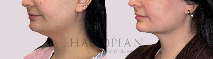 Before & After Chin Liposuction Case 288 Left Oblique View in Atlanta, GA