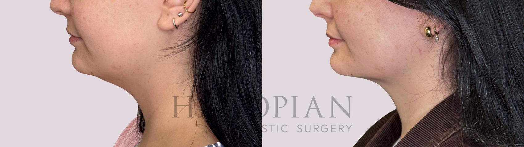 Before & After Chin Liposuction Case 288 Left Side View in Atlanta, GA