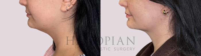 Before & After Chin Liposuction Case 288 Left Side View in Atlanta, GA