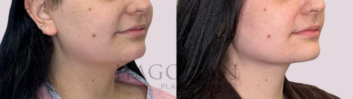 Before & After Chin Liposuction Case 288 Right Oblique View in Atlanta, GA