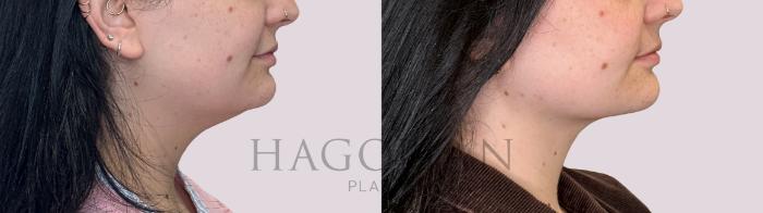 Before & After Chin Liposuction Case 288 Right Side View in Atlanta, GA