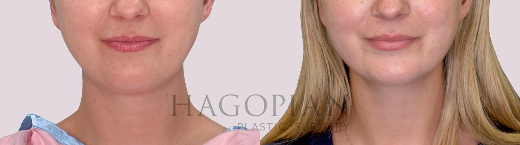 Before & After Chin Liposuction Case 294 Front View in Atlanta, GA