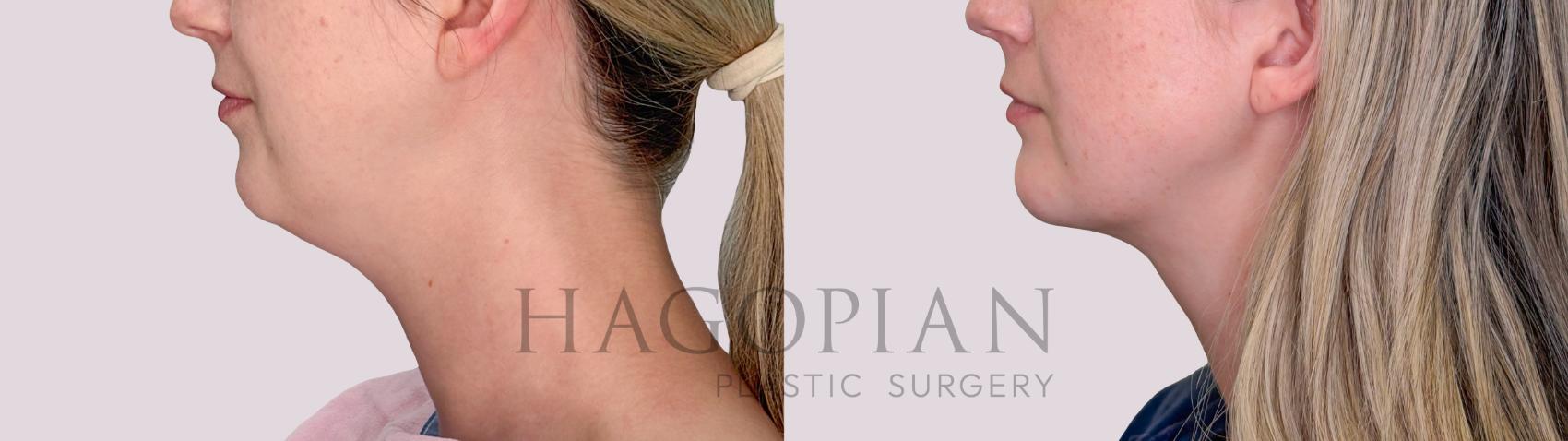 Before & After Chin Liposuction Case 294 Left Side View in Atlanta, GA