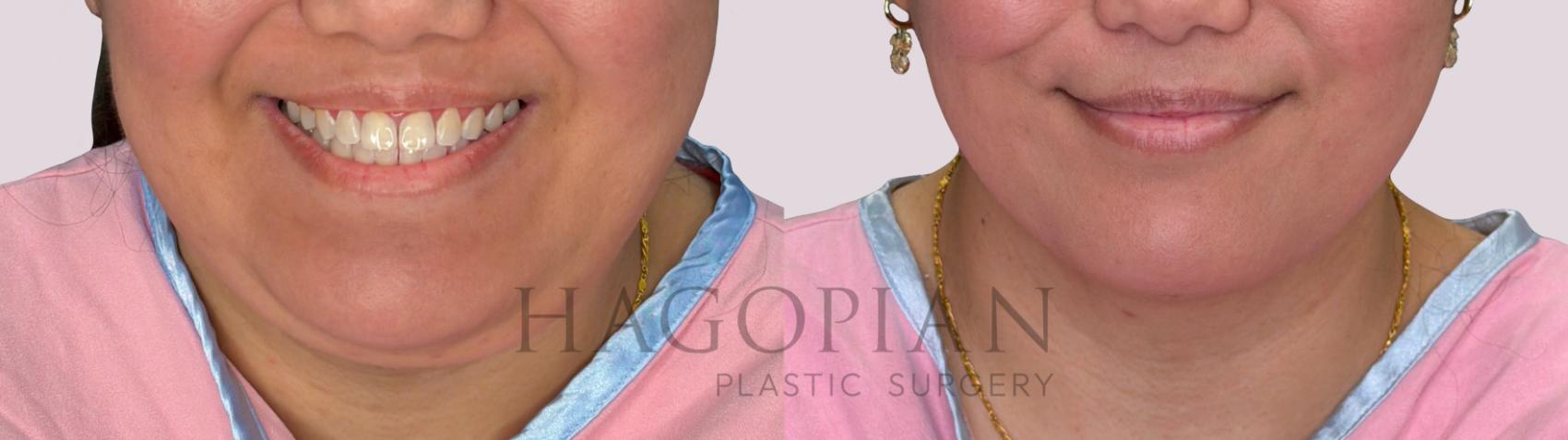 Before & After Chin Liposuction Case 295 Front View in Atlanta, GA