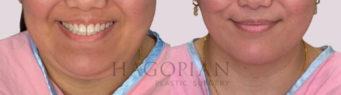 Before & After Chin Liposuction Case 295 Front View in Atlanta, GA