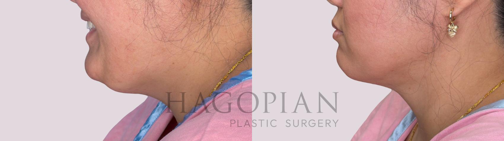Before & After Chin Liposuction Case 295 Left Side View in Atlanta, GA