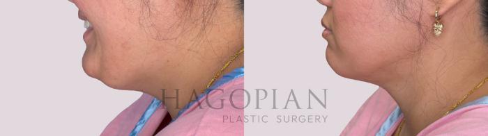 Before & After Chin Liposuction Case 295 Left Side View in Atlanta, GA