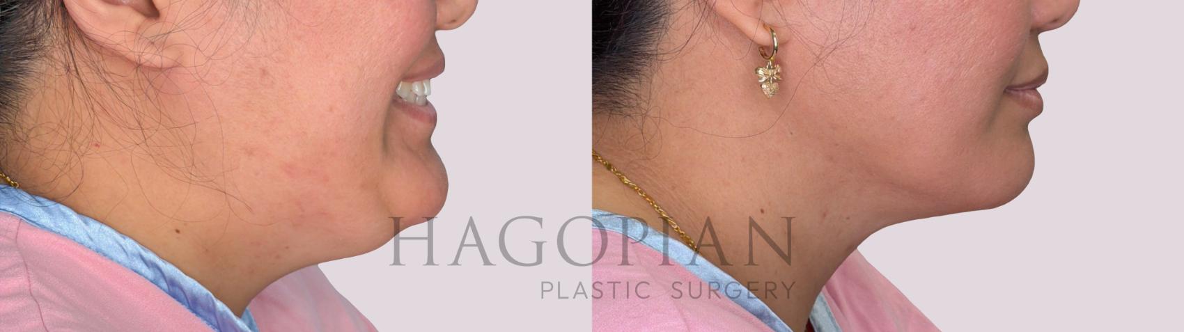 Before & After Chin Liposuction Case 295 Right Side View in Atlanta, GA