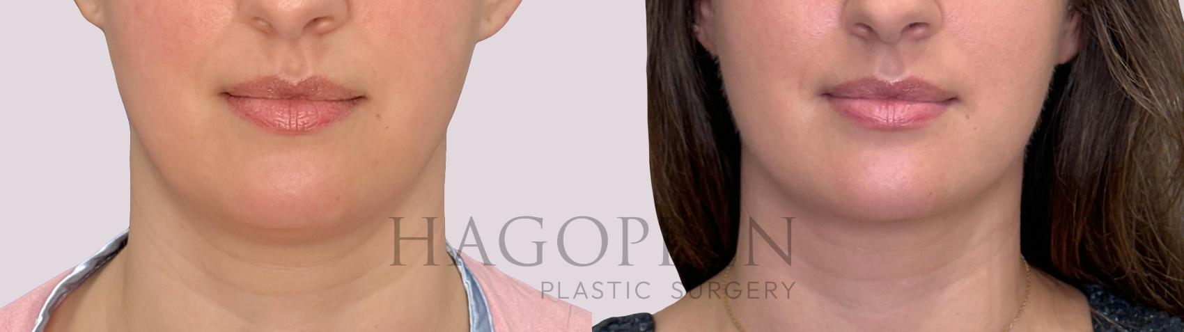 Before & After Chin Liposuction Case 297 Front View in Atlanta, GA