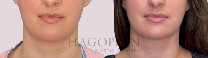 Before & After Chin Liposuction Case 297 Front View in Atlanta, GA