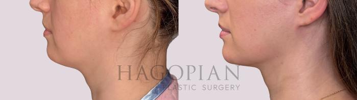 Before & After Chin Liposuction Case 297 Left Side View in Atlanta, GA