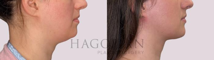 Before & After Chin Liposuction Case 297 Right Side View in Atlanta, GA
