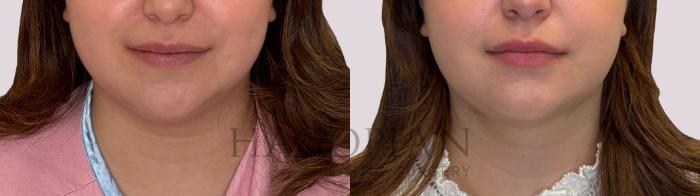Before & After Chin Liposuction Case 304 Front View in Atlanta, GA