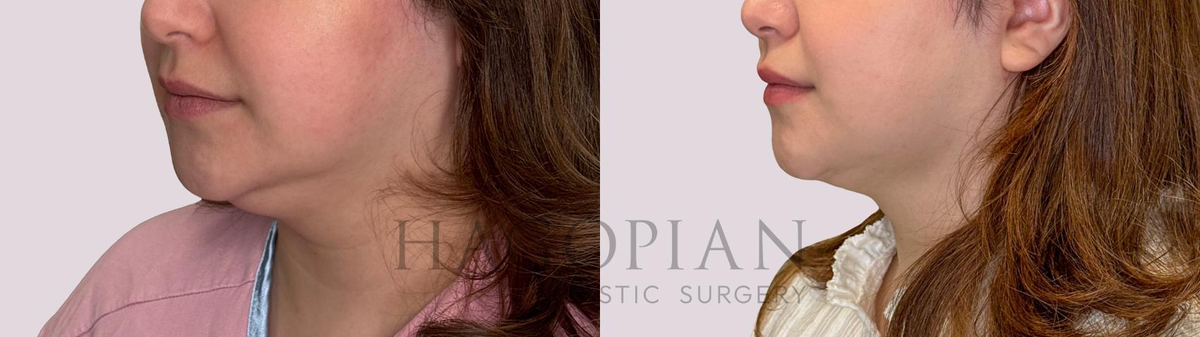 Before & After Chin Liposuction Case 304 Left Oblique View in Atlanta, GA