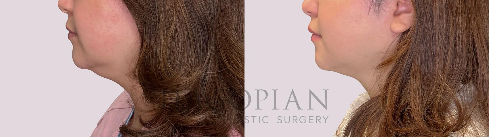 Before & After Chin Liposuction Case 304 Left Side View in Atlanta, GA
