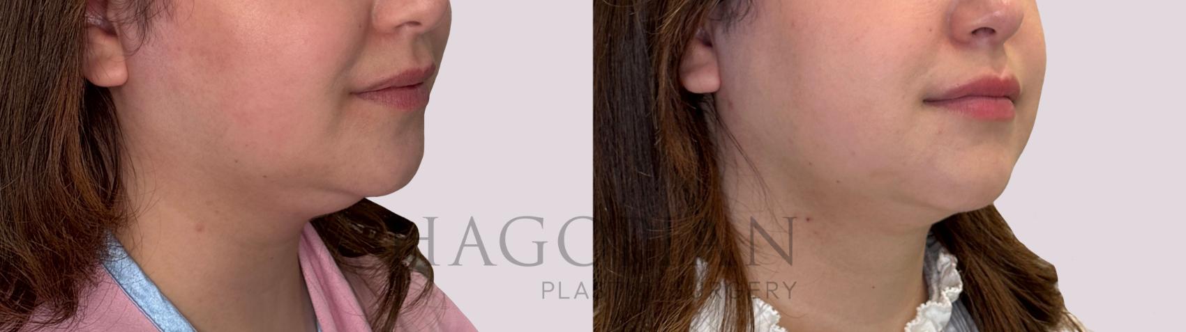 Before & After Chin Liposuction Case 304 Right Oblique View in Atlanta, GA