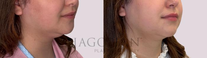 Before & After Chin Liposuction Case 304 Right Oblique View in Atlanta, GA
