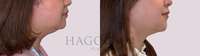Before & After Chin Liposuction Case 304 Right Side View in Atlanta, GA