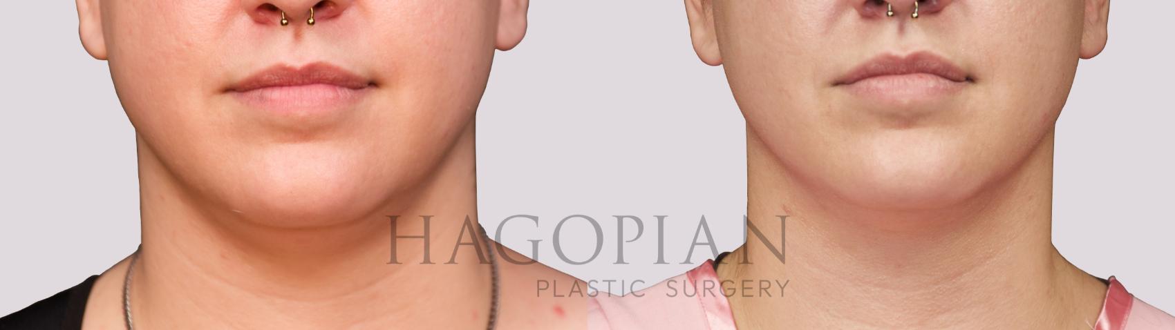Before & After Chin Liposuction Case 38 Front View in Atlanta, GA