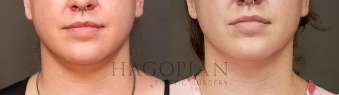 Before & After Chin Liposuction Case 38 Front View in Atlanta, GA