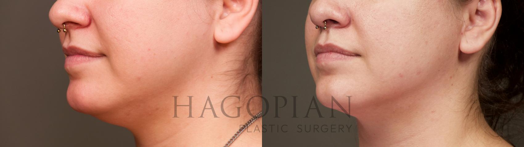 Before & After Chin Liposuction Case 38 Left Oblique View in Atlanta, GA