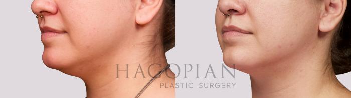 Before & After Chin Liposuction Case 38 Left Oblique View in Atlanta, GA