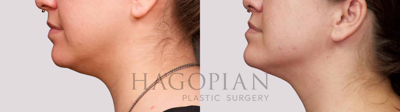 Before & After Chin Liposuction Case 38 Left Side View in Atlanta, GA