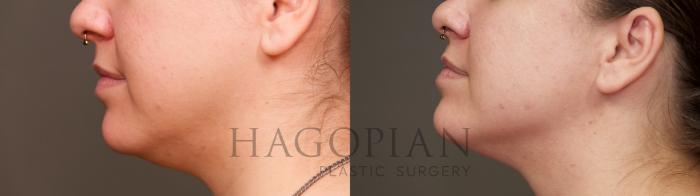 Before & After Chin Liposuction Case 38 Left Side View in Atlanta, GA
