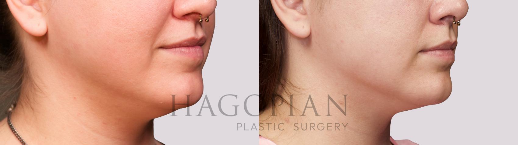 Before & After Chin Liposuction Case 38 Right Oblique View in Atlanta, GA