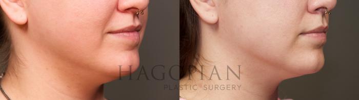 Before & After Chin Liposuction Case 38 Right Oblique View in Atlanta, GA