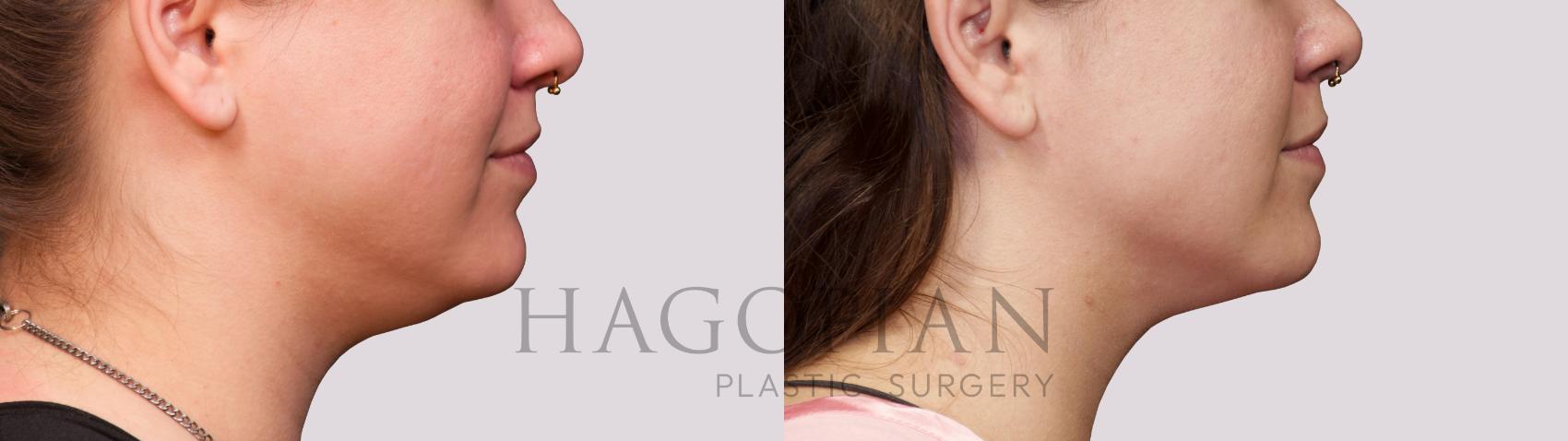 Before & After Chin Liposuction Case 38 Right Side View in Atlanta, GA