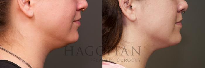 Before & After Chin Liposuction Case 38 Right Side View in Atlanta, GA