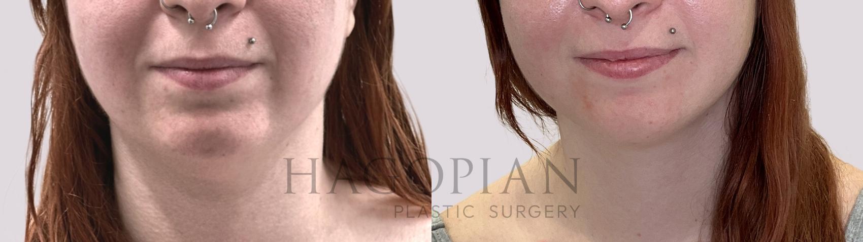 Before & After Chin Liposuction Case 70 Front View in Atlanta, GA