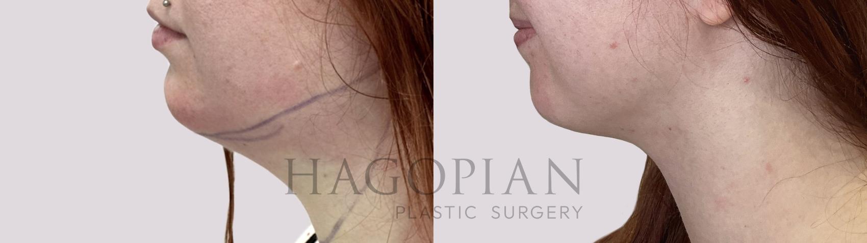 Before & After Chin Liposuction Case 70 Left Side View in Atlanta, GA