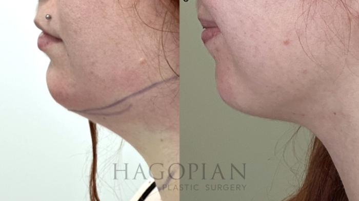 Before & After Chin Liposuction Case 70 Left Side View in Atlanta, GA