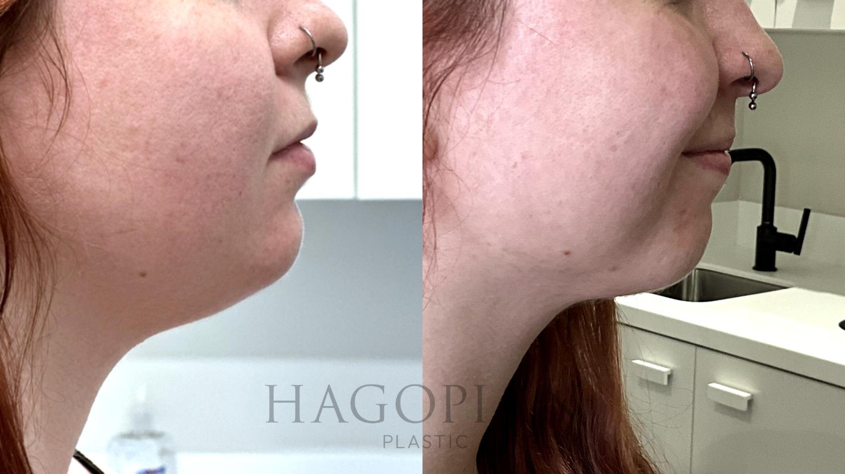 Before & After Chin Liposuction Case 70 Right Side View in Atlanta, GA