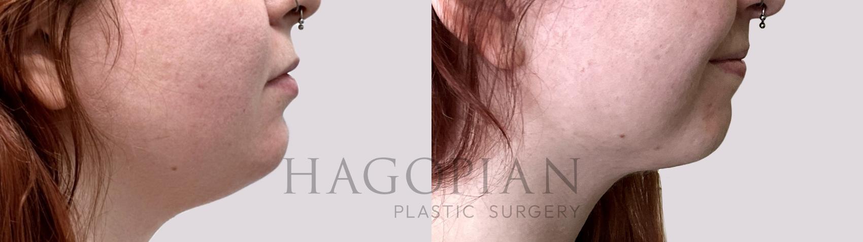 Chin Liposuction in Atlanta, GA – Hagopian Plastic Surgery