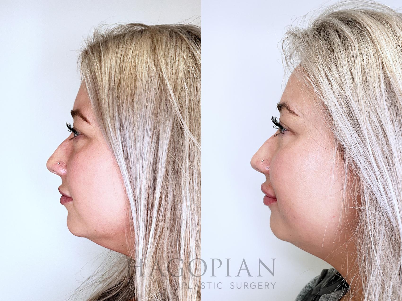 Before & After Chin Liposuction Case 79 Left Side View in Atlanta, GA