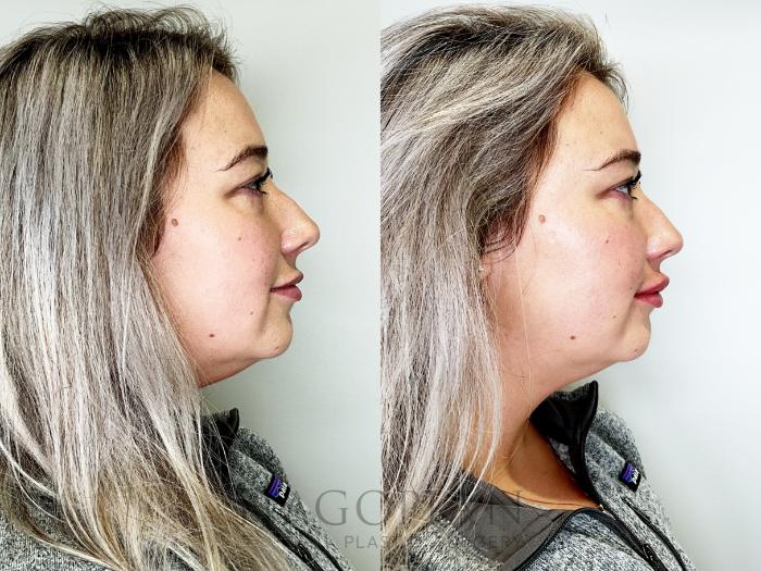 Before & After Chin Liposuction Case 79 Right Side View in Atlanta, GA