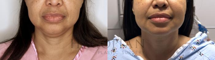 Before & After Chin Liposuction Case 84 Front View in Atlanta, GA