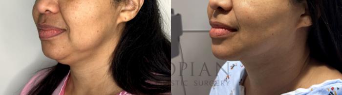 Before & After Chin Liposuction Case 84 Left Oblique View in Atlanta, GA