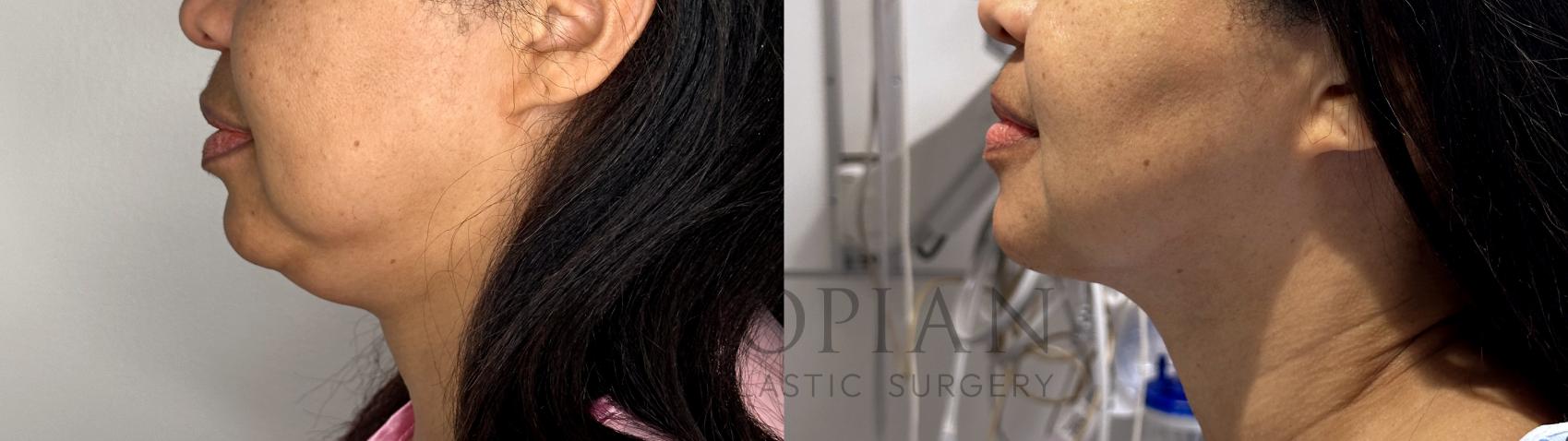 Before & After Chin Liposuction Case 84 Left Side View in Atlanta, GA