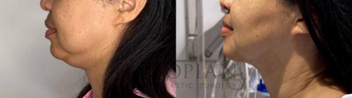 Before & After Chin Liposuction Case 84 Left Side View in Atlanta, GA