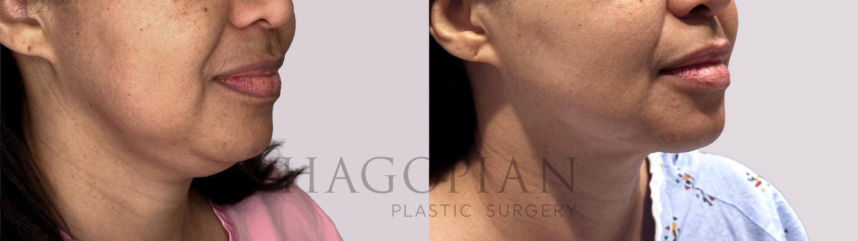 Before & After Chin Liposuction Case 84 Right Oblique View in Atlanta, GA