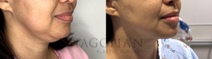 Before & After Chin Liposuction Case 84 Right Oblique View in Atlanta, GA